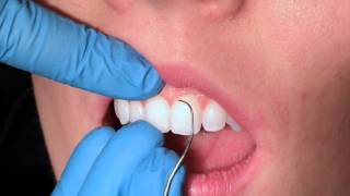 Exploring Anterior Teeth