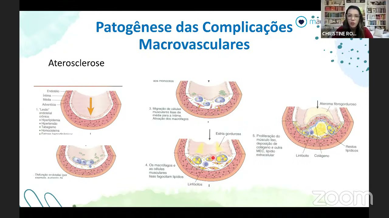 Complicações crônicas do Diabetes Mellitus - Patogênese