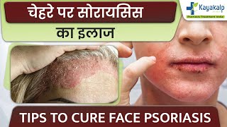 चेहरे पर सोरायसिस का कारण, लक्षण और इलाज  | Tips to heal Psoriasis on Face (Facial Psoriasis)