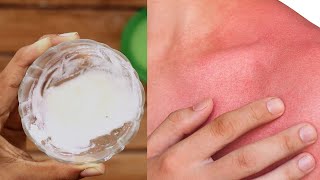 Get rid of heat rash, hives and prickly heat on face overnight