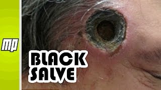Black Salve - Cancer &#39;Treatment&#39; That Burns Holes in You!