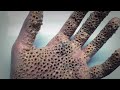 Trypophobia Test - Do you have a fear of small holes?