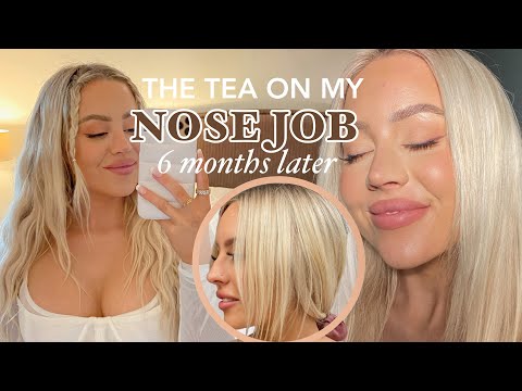 6 month nose job update, regrets, advice | kasey rayton