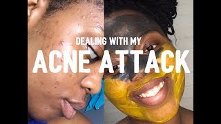ACNE ATTACK| Hardships of dealing with acne & scars | South African Youtuber