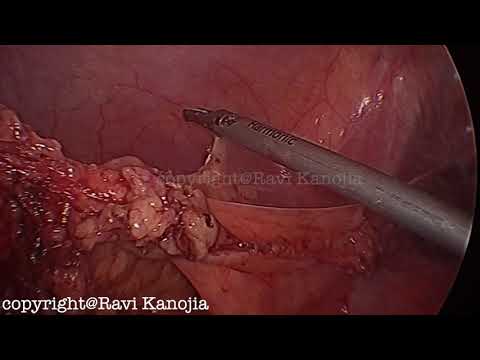 One-Stage laparoskopische Duhamel-Operation bei Morbus Hirschsprung