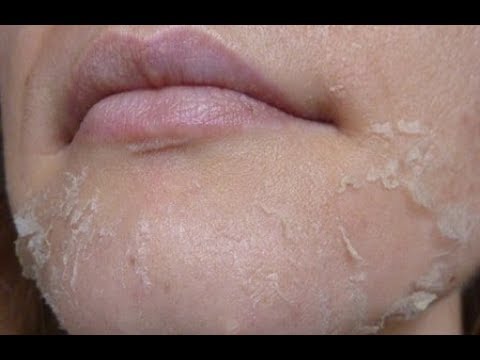 Отбеливающий крем от клиник Веснушки калуга официальный сайт