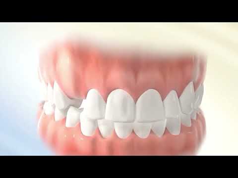 Orthodontic Treatment of Impacted Canine |
