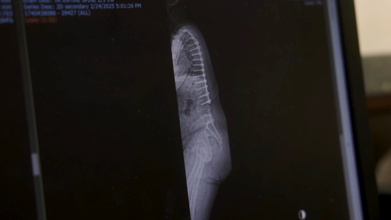 Spine surgery puts TV cameraman’s life back in focus