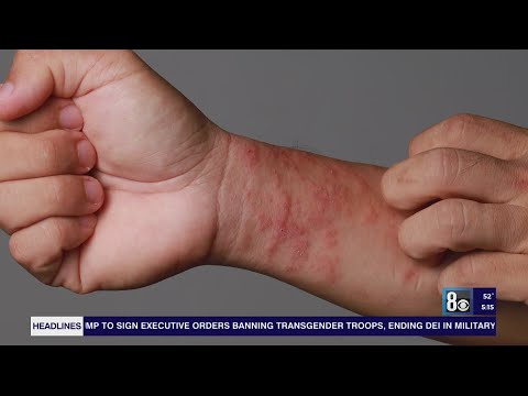 Las Vegas dermatologist's tips on how to combat dry, itchy skin during winter months