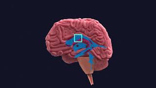 Brain Bleeds in Babies: Posthemorrhagic Hydrocephalus