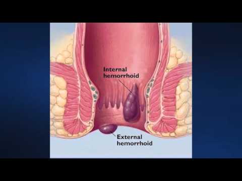 Rubber Bands Relieve Hemorrhoids