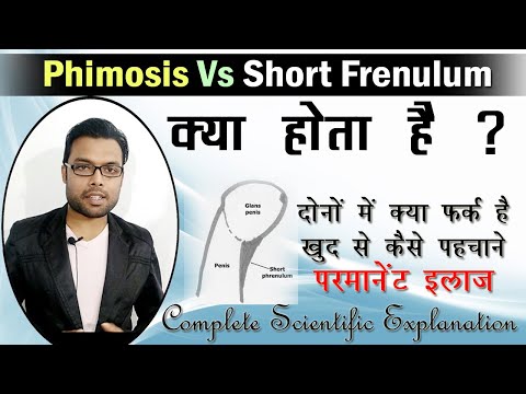 फिमोसिस और टाइट फ्रेनुलम का इलाज | Phimosis Vs short frenulum | Phimosis cure | Dr. Nitish Kumar Video