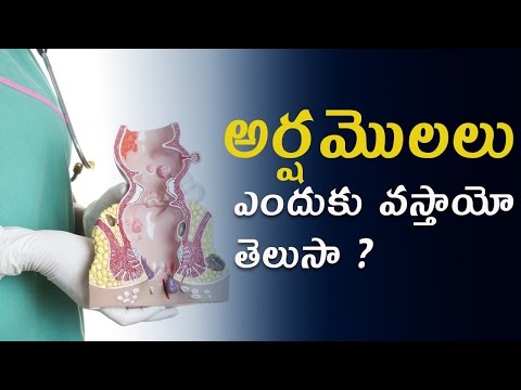 శాశ్వతంగా మొలలు,పైల్స్ పోవాలంటే ఈ వీడియో చూడండి | Dr.T. Lakshmikanth | #pilessurgeon #hemorrhoids