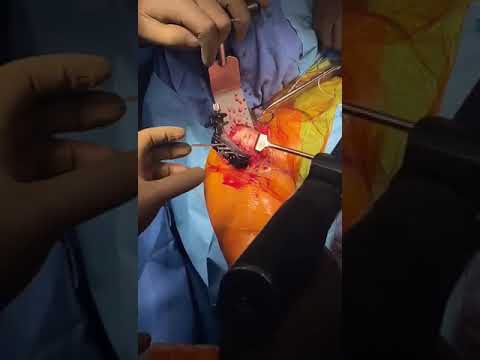 Shoulder Replacement Live Surgery Video Dr Manit Arora