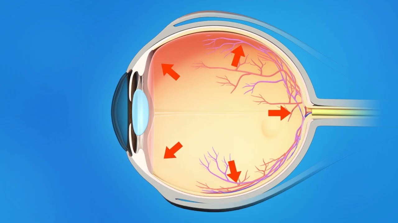 Glaucoma Overview