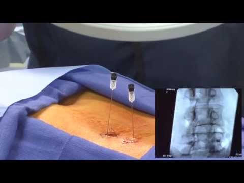 WATCH an Epidural Steroid Injection Demonstration - LIVE!