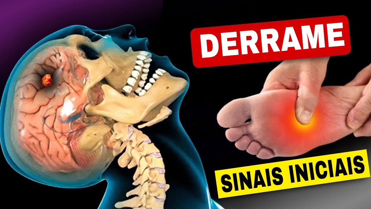 8 Sinais de Alerta de DERRAME CEREBRAL (AVC) Um Mês Antes + 9 Dicas Poderosas para Evitar