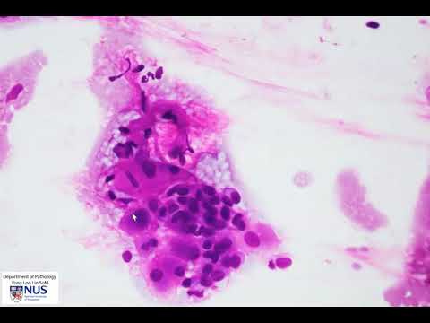 Cytology of Low grade mucoepidermoid carcinoma