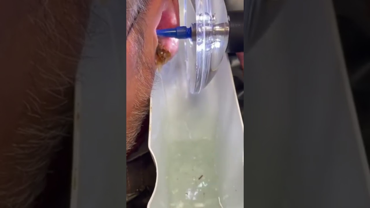 Video mostrando uma lavagem no ouvido sendo realizada.