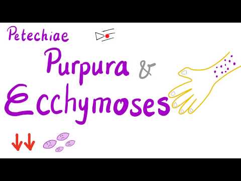 Petechiae, Purpura and Ecchymoses