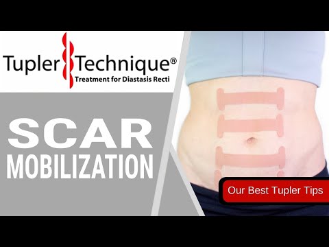 Scar Mobilization