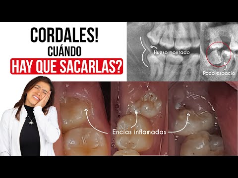 Cuándo debo sacarme las cordales? 🤓