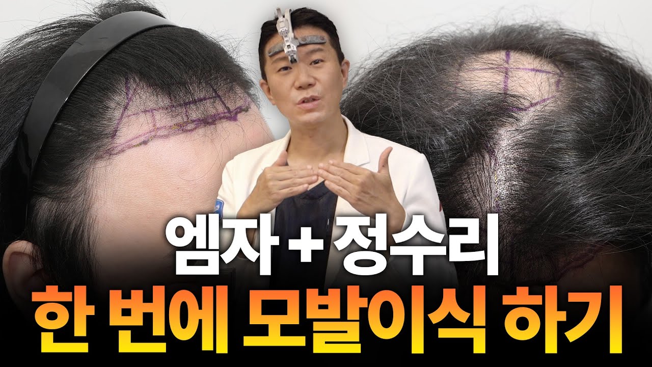 정수리 모발이식 결과도 좋을까? 비절개 모발이식 결과 보기