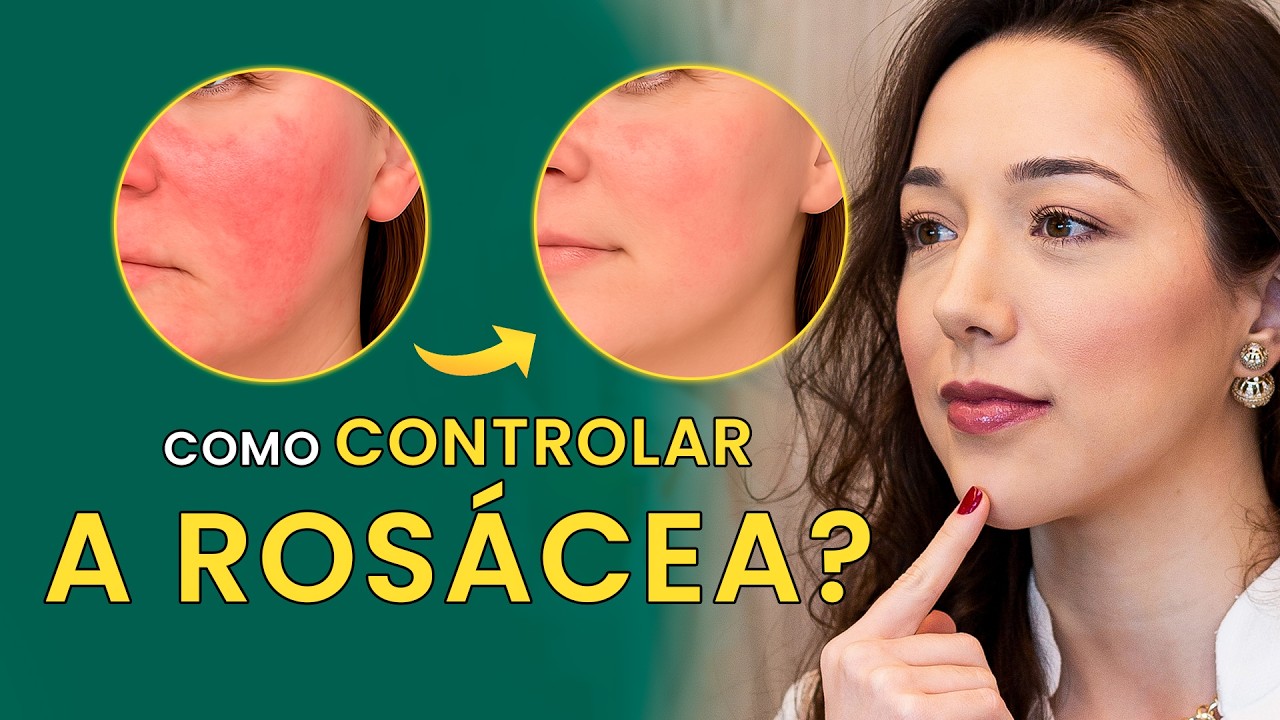 ROSÁCEA: O que é, como controlar, skincare e principais tratamentos disponíveis
