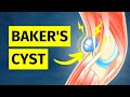 How To ACTUALLY Treat A Baker S Cyst Pain Behind Knee