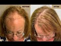 When Sherry first came to us about two years ago, she was completely distraught from her hair loss.