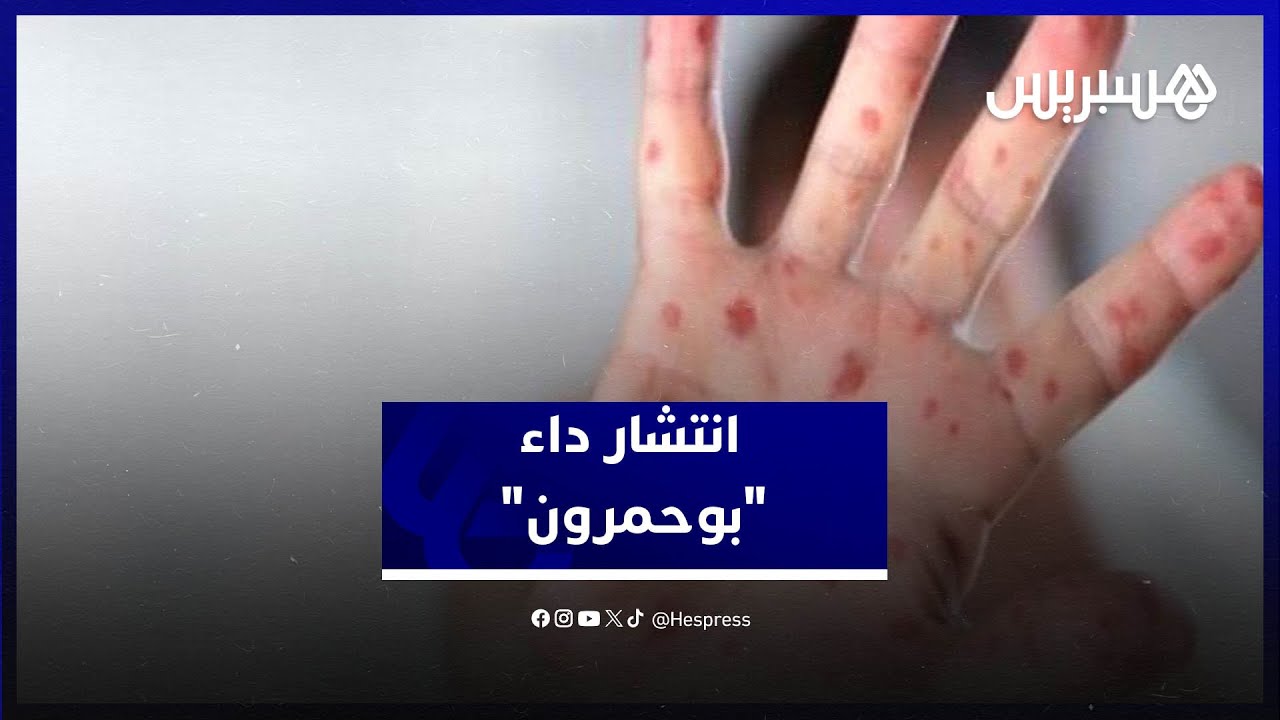 أخصائي في طب الأطفال يحذر من انتشار "بوحمرون" ويوصي بالتلقيح thumbnail