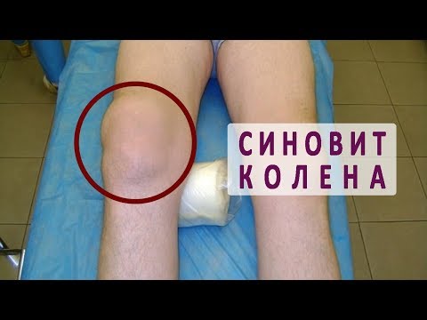 Синовит коленного сустава