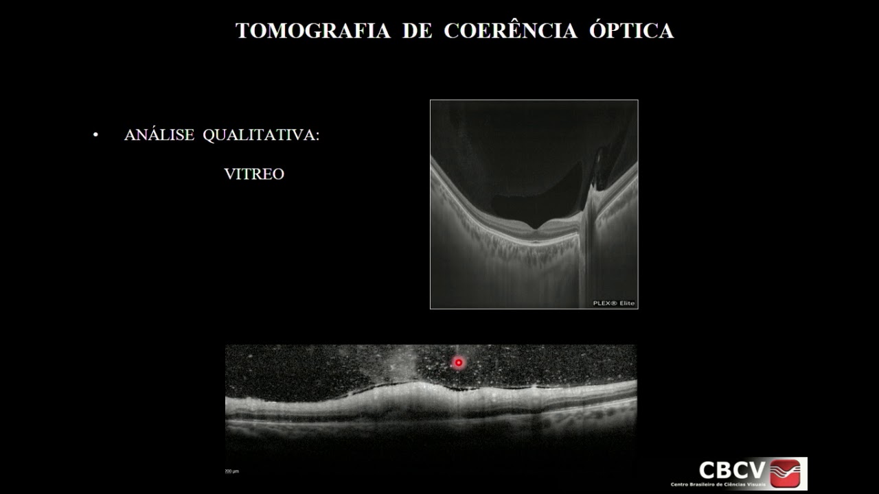 OCT - Tomografia de Coerência Óptica - Dra. Erika Pacheco Magalhães Diniz