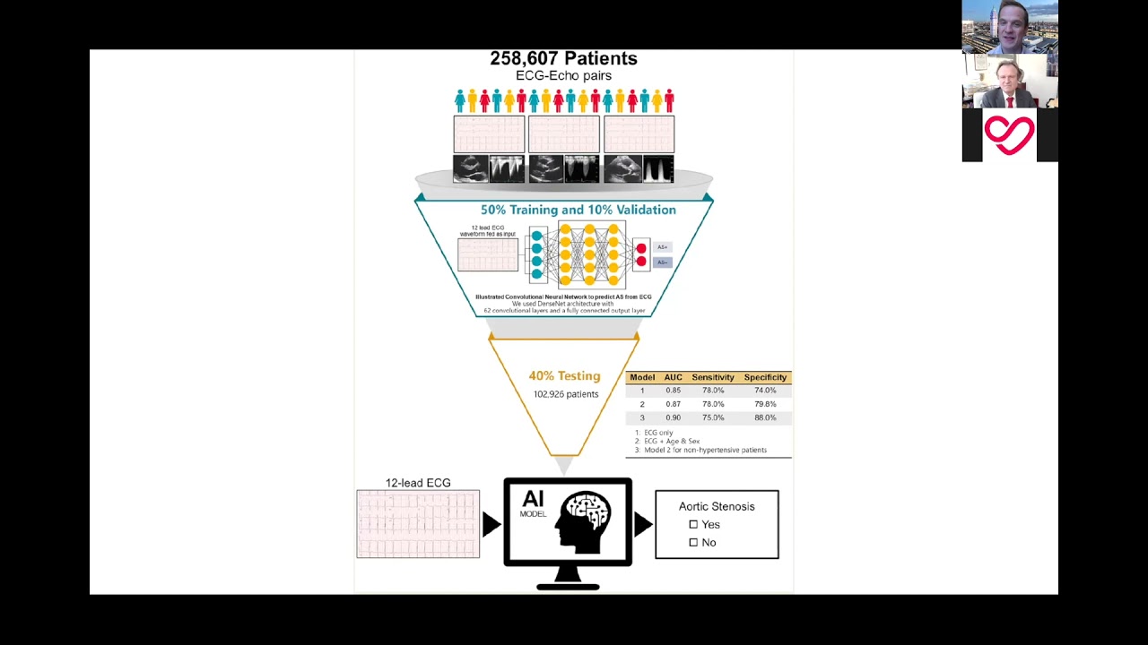 Electrocardiogram Screening for Aortic Valve Stenosis Using Artificial Intelligence