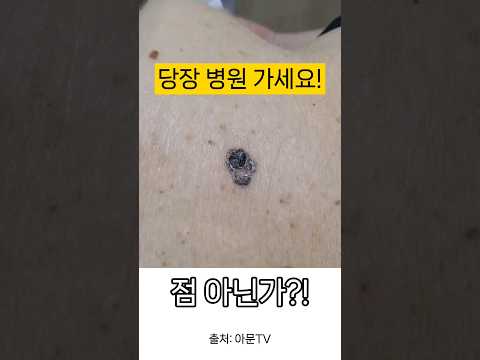 점인가, 피부암인가?! (병원 의사 수술 nevus, skin cancer)[아문TV]