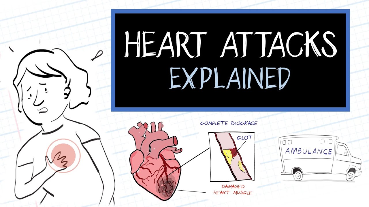 What is a Heart Attack? (HealthSketch)
