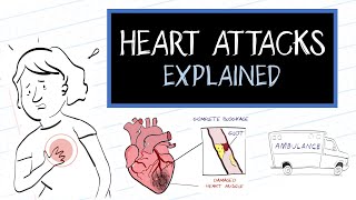 Download lagu What is a Heart Attack? (HealthSketch) mp3