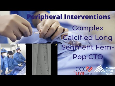 Complex Calcified Long Segment Fem-Pop CTO