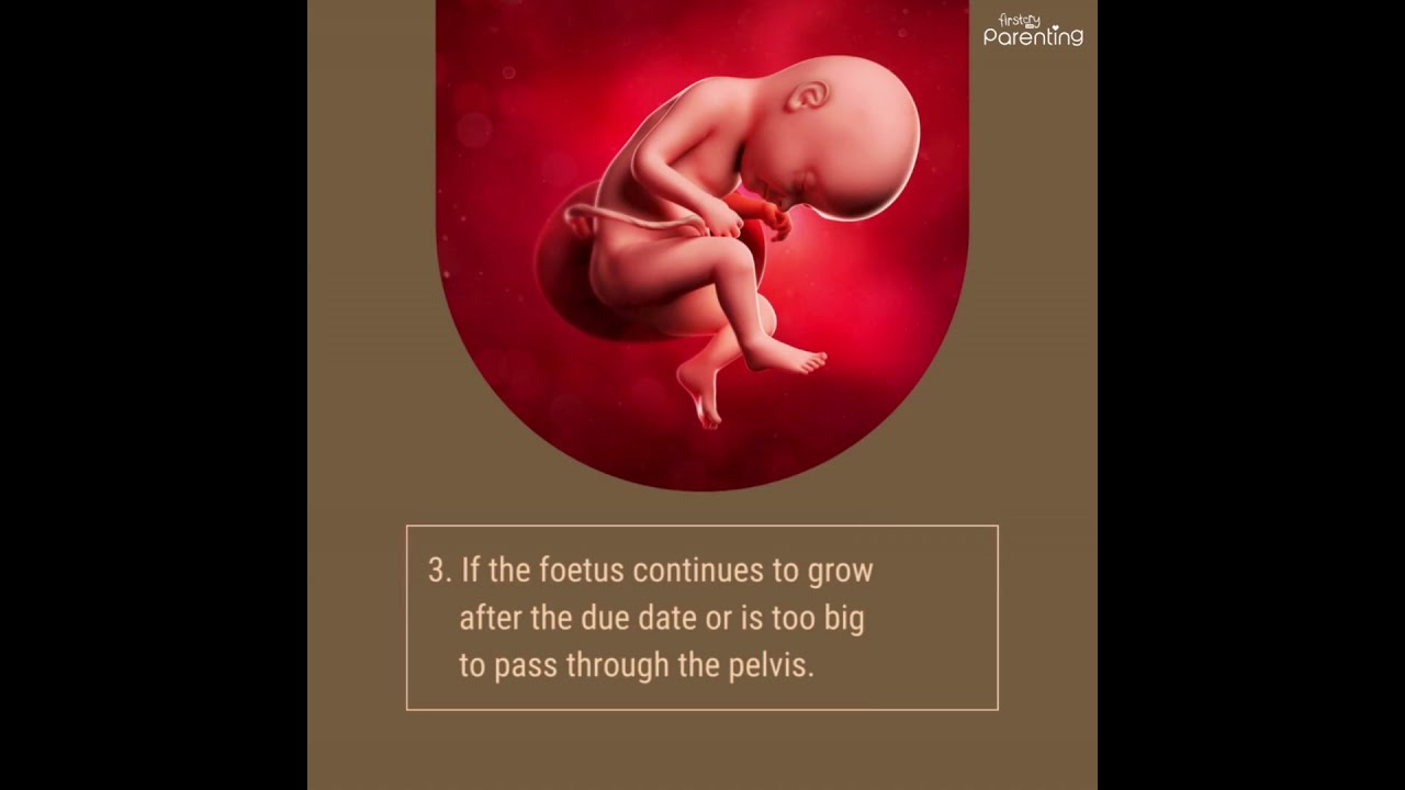 Prolonged Labour - Know the Risks