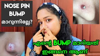 How To Get Rid Of Nose Piercing Bump FAST!! |Home remedy for nose piercing bump