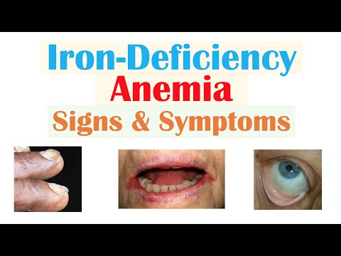 Iron-Deficiency Anemia Signs & Symptoms (ex. Fatigue, “Spoon Nails”, Cracked Lips)