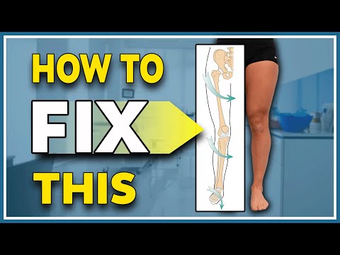 The most overlooked cause of knee pain - Patellar endotorsion