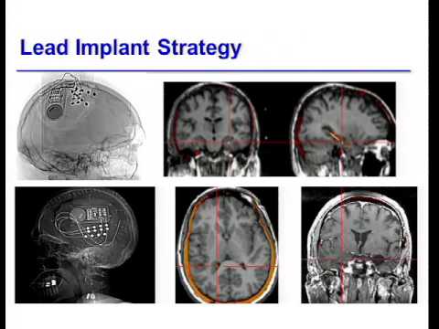 Responsive direct brain stimulation for the treatment of epilepsy