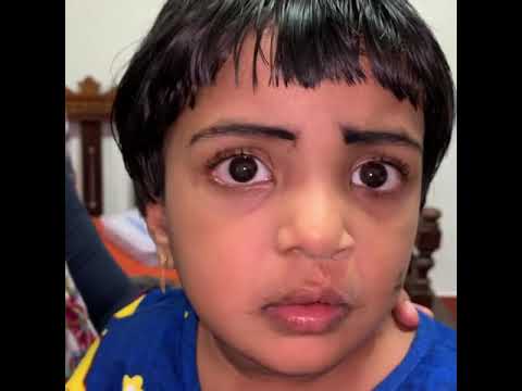 Two Years After Cleft Lip Surgery- Happy Patient