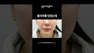 팔자주름 5분만에 지우는 법 👋