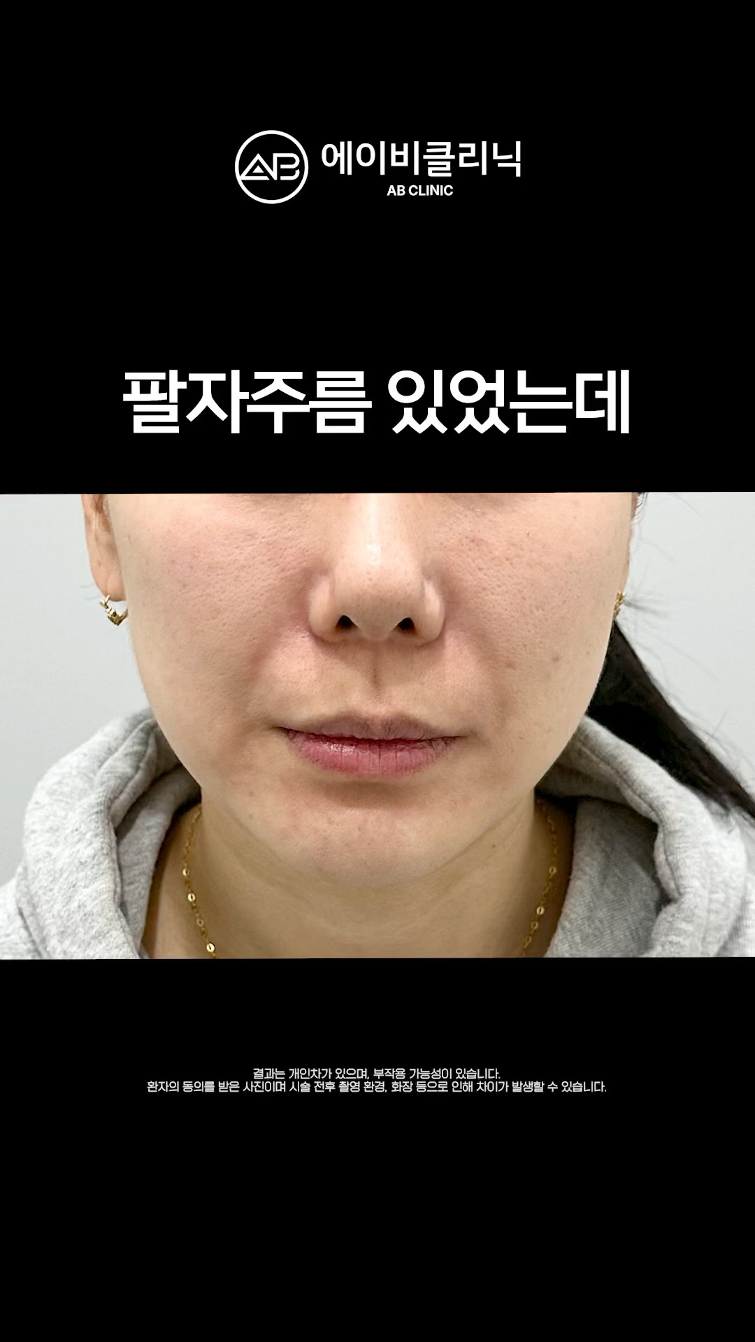 팔자주름 5분만에 지우는 법 👋