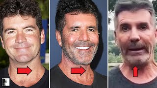 Simon Cowell’s Transformation Explained by a Facial Surgeon!
