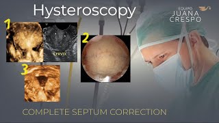 Complete Septum Resection (ESHRE U2b)