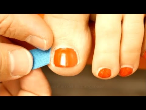 Podo-Taping-Concept© Nagelfalz Tape, eingewachsener Zehen - Nagel, ingrown Nail , unguis incarnatus