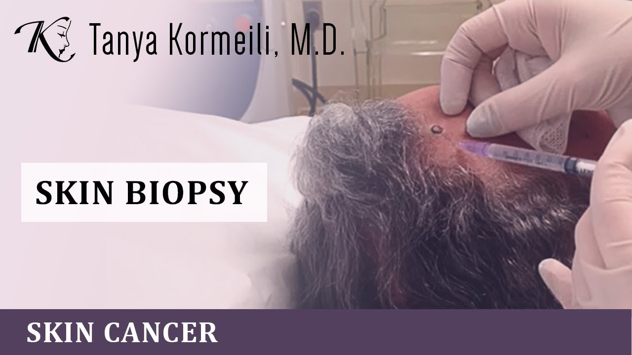 Mole Removal in Santa Monica & Beverly Hills